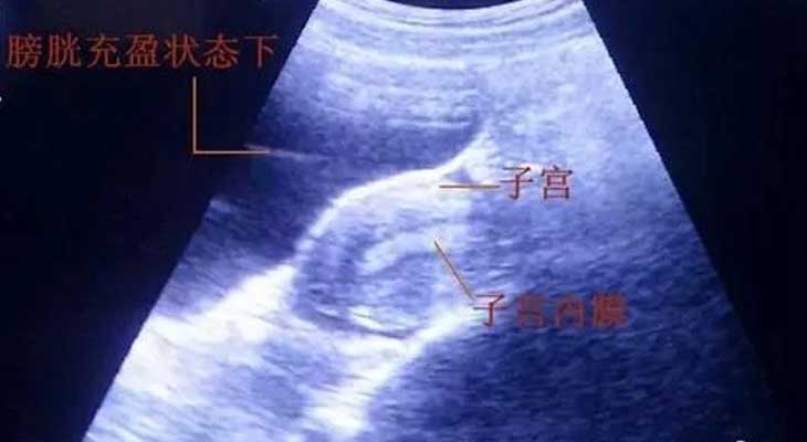金宝宝助孕[广州传承助孕 电话]+营口姐妹为啥试管婴儿胚胎移植前要憋尿呢？
